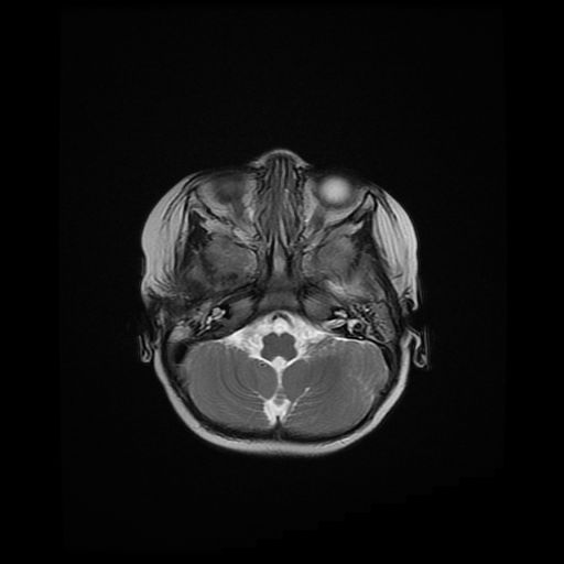 File:Acute phase of hemiconvulsion-hemiplegia epilepsy syndrome (Radiopaedia 29309-29745 Axial T2 19).jpg