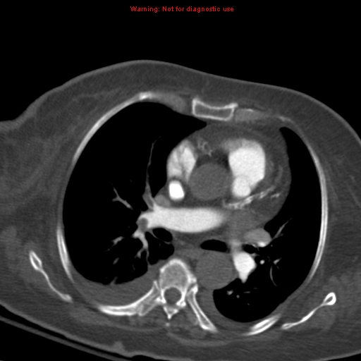 File:Acute pulmonary embolism (Radiopaedia 13286-13289 Axial C+ CTPA 33).jpg