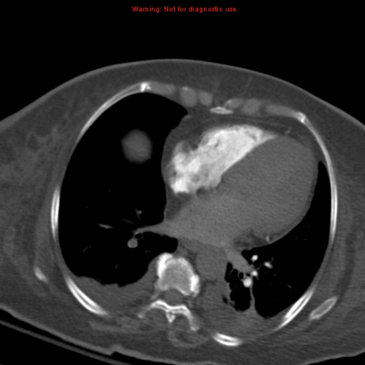 Acute pulmonary embolism (Radiopaedia 13286-13289 Axial C+ CTPA 43).jpg