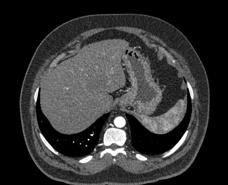 Acute pulmonary embolism with pulmonary infarcts (Radiopaedia 77688-89908 Axial C+ CTPA 61).jpg