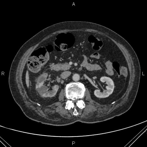 Acute renal artery occlusion (Radiopaedia 86586-102682 Axial C+ portal venous phase 33).jpg