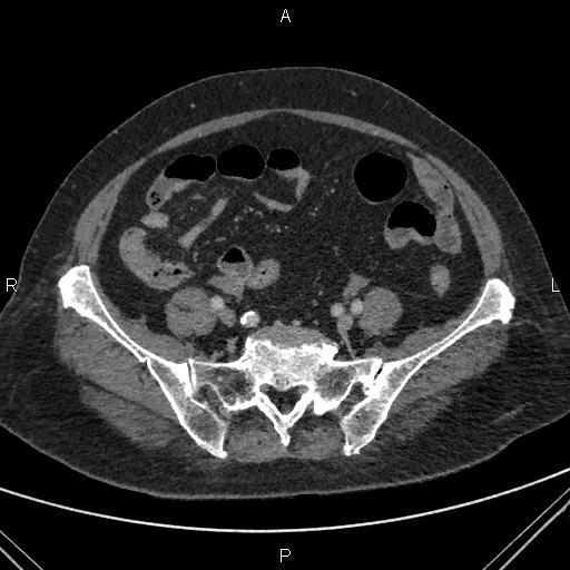 File:Acute renal artery occlusion (Radiopaedia 86586-102682 Axial C+ portal venous phase 71).jpg