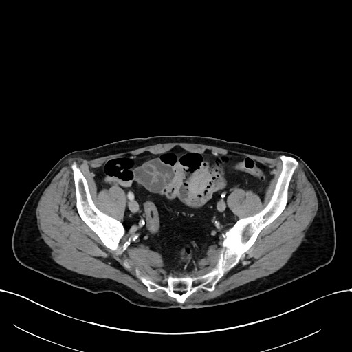 Acute renal infarction (Radiopaedia 59375-66736 Axial C+ portal venous phase 93).jpg