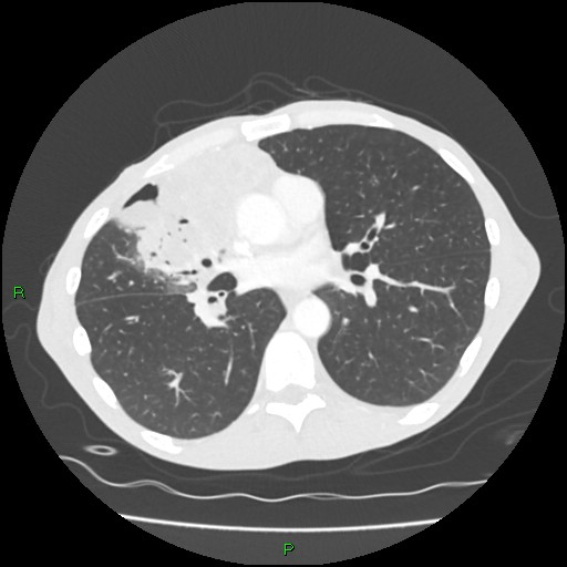 File:Acute right lung abscess (Radiopaedia 34806-36258 Axial lung window 101).jpg