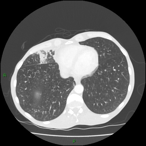 Acute right lung abscess (Radiopaedia 34806-36258 Axial lung window 143).jpg