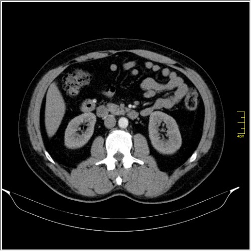 Acute right sided diverticulitis (Radiopaedia 65249-74268 Axial C+ portal venous phase 34).JPG