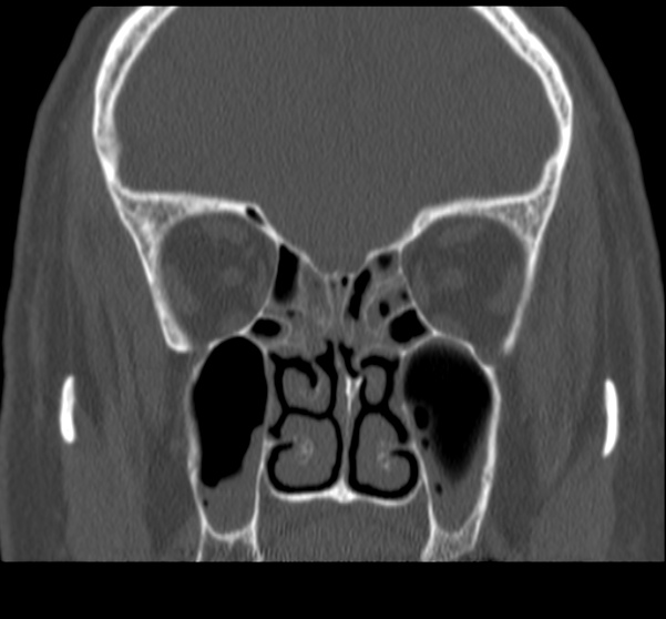 Acute sinusitis (Radiopaedia 23161-23215 Coronal bone window 38).jpg