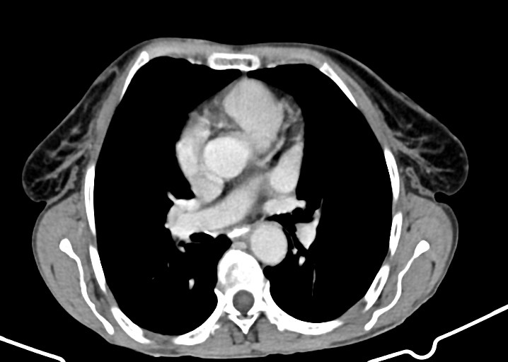 Acute small bowel (ileal) volvulus (Radiopaedia 71740-82139 Axial C+ portal venous phase 11).jpg