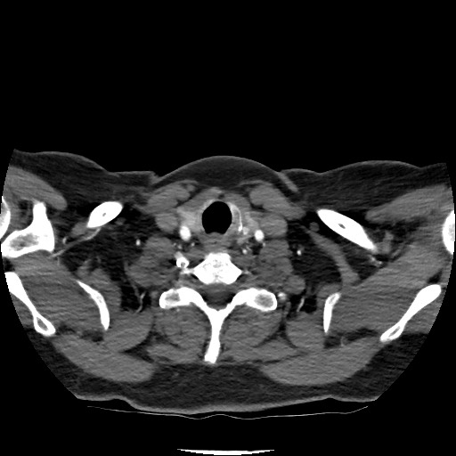 Acute subarachnoid hemorrhage and accessory anterior cerebral artery (Radiopaedia 69231-79009 Axial C+ arterial phase 34).jpg