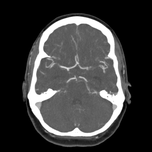 Acute subarachnoid hemorrhage and accessory anterior cerebral artery (Radiopaedia 69231-79009 D 25).jpg