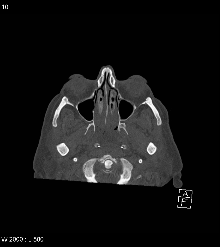 Acute subdural hematoma with myelofibrosis (Radiopaedia 52582-58494 Axial bone window 5).jpg