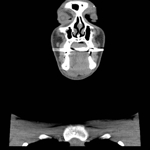 File:Acute submandibular sialadenitis secondary to ductal stone (Radiopaedia 27999-28267 Coronal C+ delayed 14).jpg