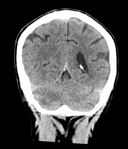 File:Acute superior cerebellar artery territory infarct (Radiopaedia 84104-99359 Coronal non-contrast 66).jpg