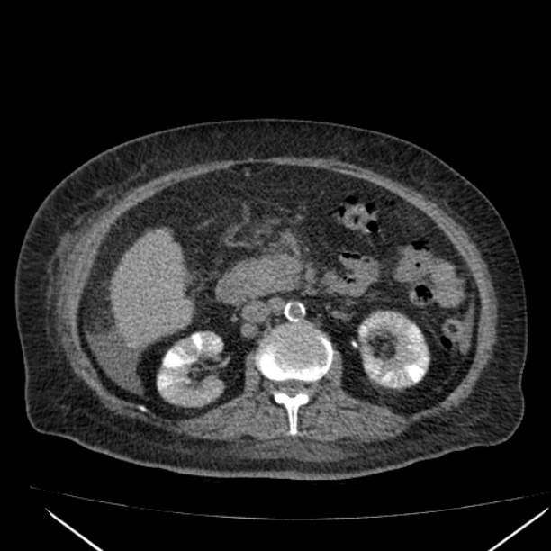 Acute tubular necrosis (Radiopaedia 28077-28334 Axial non-contrast 31).jpg