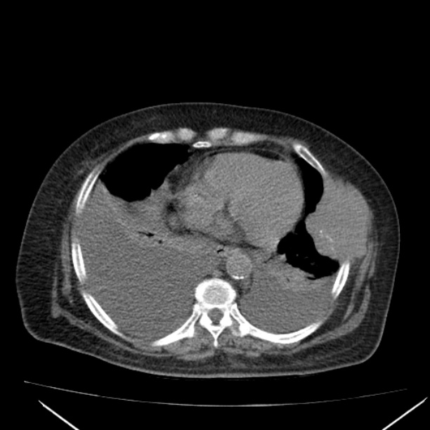 Acute tubular necrosis (Radiopaedia 28077-28334 F 6).jpg