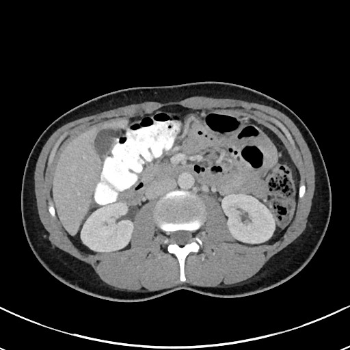 Acute uncomplicated appendicitis (Radiopaedia 61374-69304 Axial C+ portal venous phase 47).jpg
