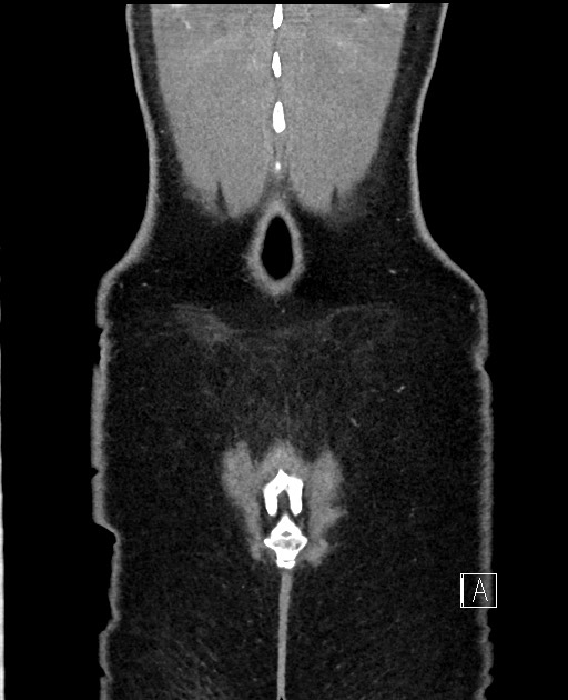 Acute uncomplicated appendicitis (Radiopaedia 61374-69304 Coronal C+ portal venous phase 102).jpg