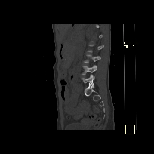 File:Acute vertebral compression fracture (Radiopaedia 63832-72559 Sagittal bone window 1).jpg