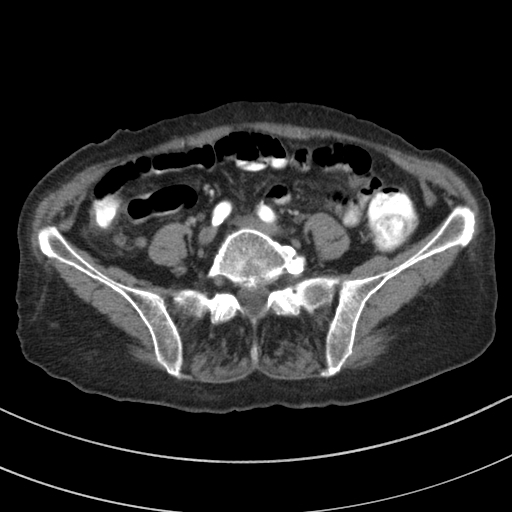 Adenocarcinoma of cecum (Radiopaedia 59222-66549 Axial C+ arterial phase 103).jpg