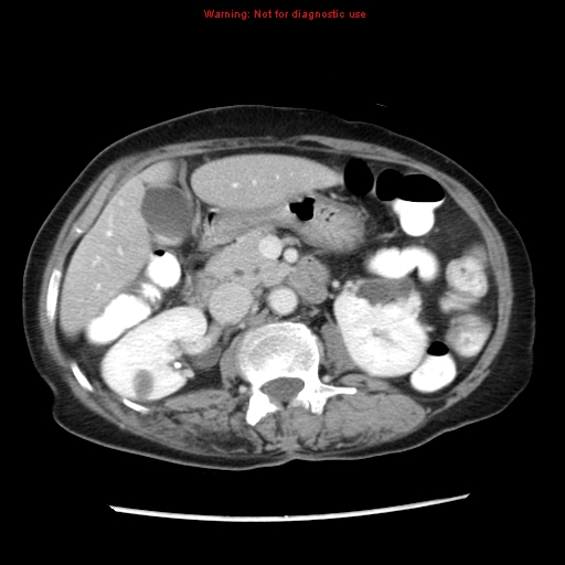 File:Adenocarcinoma of the colon (Radiopaedia 8191-9039 Axial liver window 30).jpg