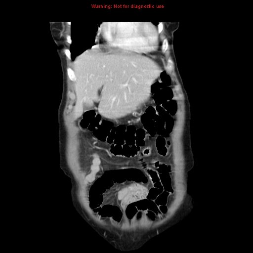 File:Adenocarcinoma of the colon (Radiopaedia 8191-9039 Coronal liver window 10).jpg
