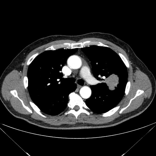 Adenocarcinoma of the lung (Radiopaedia 59871-67325 Axial C+ arterial phase 36).jpg