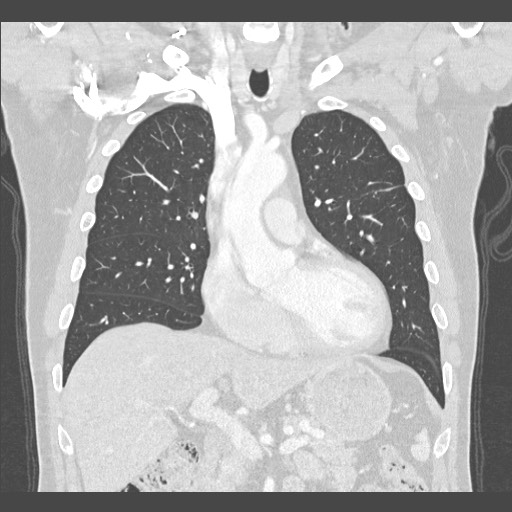 Adenocarcinoma of the lung (Radiopaedia 59871-67325 Coronal lung window 20).jpg