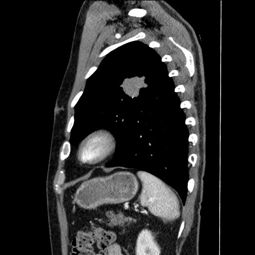 Adenocarcinoma of the lung (Radiopaedia 59871-67325 Sagittal C+ arterial phase 82).jpg