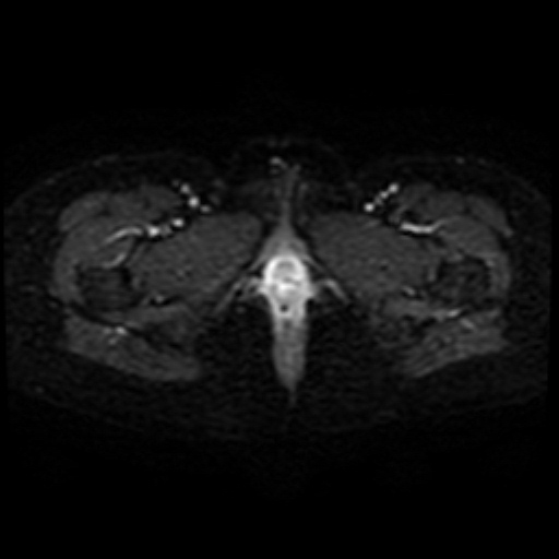 Adenoma malignum of cervix (Radiopaedia 66441-75705 Axial DWI 25).jpg