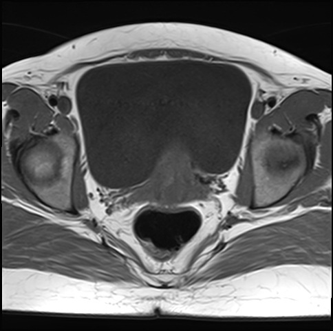 File:Adenomyosis - ovarian endometriomas (Radiopaedia 67031-76350 Axial T1 19).jpg