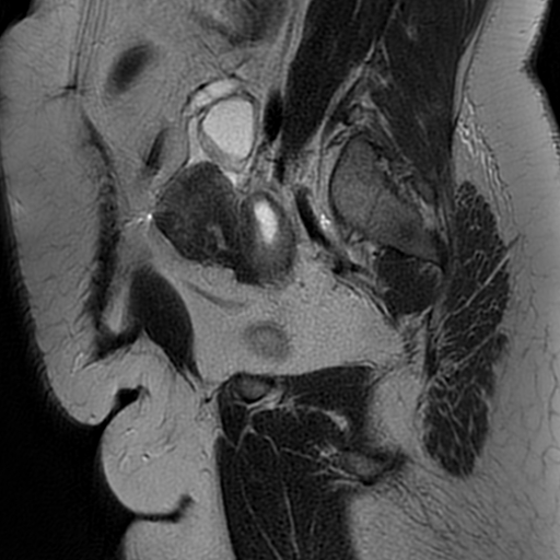 File:Adenomyosis within a didelphys uterus (Radiopaedia 70175-80215 Sagittal T2 28).jpg