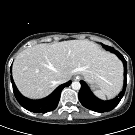 File:Adhesional small bowel obstruction (Radiopaedia 48397-53305 Axial C+ portal venous phase 7).jpg
