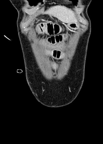 File:Adhesional small bowel obstruction (Radiopaedia 48397-53305 Coronal C+ portal venous phase 42).jpg