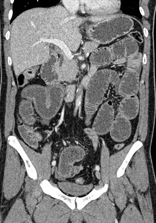 Adhesional small bowel obstruction (Radiopaedia 58900-66131 Coronal C+ portal venous phase 132).jpg