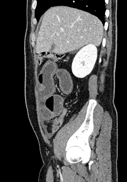 Adhesional small bowel obstruction (Radiopaedia 58900-66131 Sagittal C+ portal venous phase 65).jpg