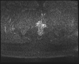 Adnexal multilocular cyst (O-RADS US 3- O-RADS MRI 3) (Radiopaedia 87426-103754 Axial DWI 60).jpg