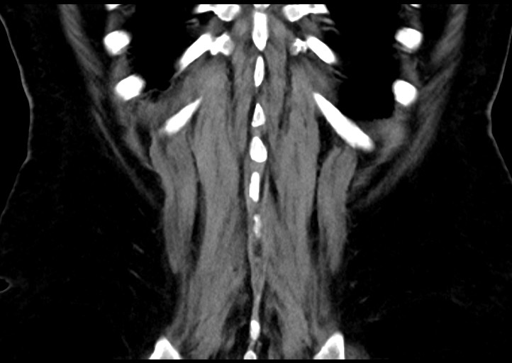 Adrenal cortical carcinoma (Radiopaedia 64017-72769 Coronal C+ portal venous phase 48).jpg