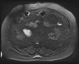 Adrenal cortical carcinoma (Radiopaedia 64017-72770 Axial DWI 108).jpg