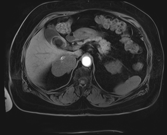 Adrenal cortical carcinoma (Radiopaedia 64017-72770 Axial T1 C+ fat sat 8).jpg
