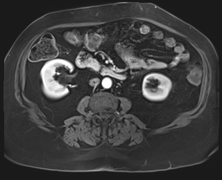File:Adrenal cortical carcinoma (Radiopaedia 64017-72770 I 54).jpg
