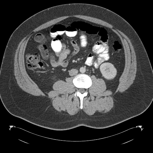 File:Adrenal cyst (Radiopaedia 45625-49776 Axial C+ portal venous phase 52).png