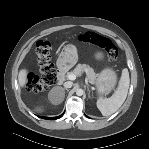 File:Adrenal cyst (Radiopaedia 45625-49777 Axial C+ portal venous phase 34).png