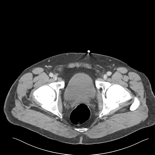 Adrenal cyst (Radiopaedia 45625-49777 Axial C+ portal venous phase 97).png