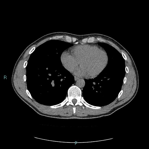 File:Adrenal cystic lymphangioma (Radiopaedia 83161-97534 Axial non-contrast 2).jpg