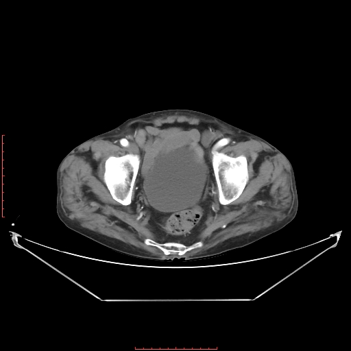 Adrenal hemangioma (Radiopaedia 68923-78668 Axial C+ arterial phase 65).jpg