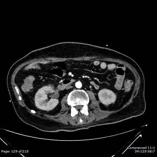 File:Adrenal metastasis (Radiopaedia 78425-91079 Axial C+ arterial phase 59).jpg