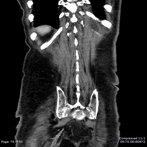 Adrenal metastasis (Radiopaedia 78425-91079 Sagittal C+ portal venous phase 63).jpg