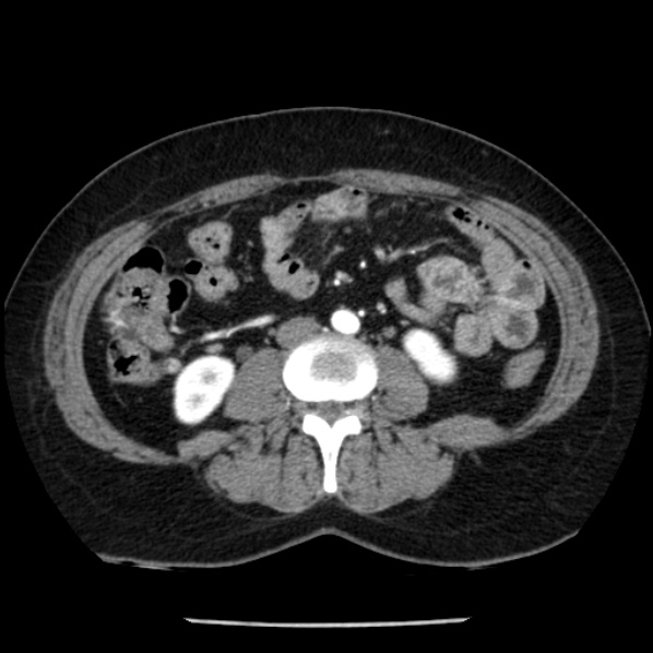 Adrenal myelolipoma (Radiopaedia 43401-46759 Axial C+ arterial phase 57).jpg