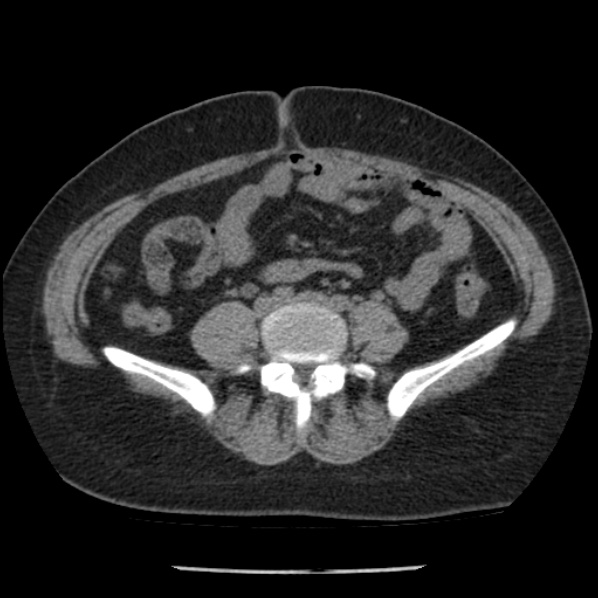 Adrenal myelolipoma (Radiopaedia 43401-46759 Axial non-contrast 56).jpg