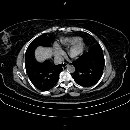 Adrenal myelolipoma (Radiopaedia 82742-96986 Axial non-contrast 1).jpg